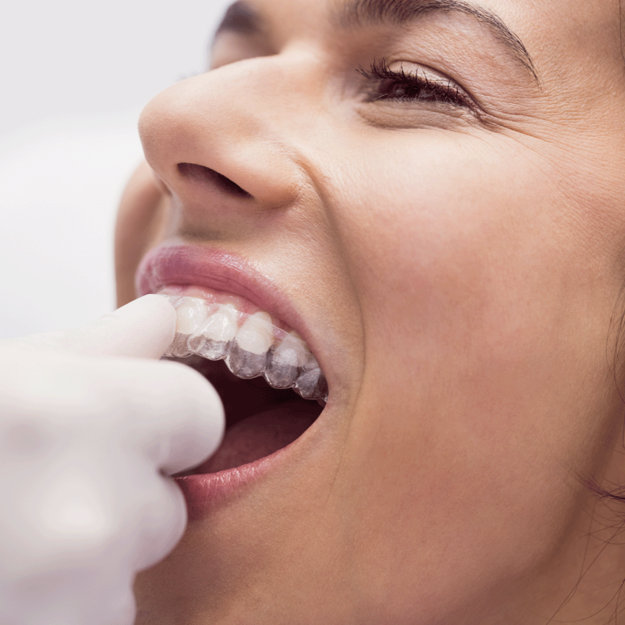 Apparecchi ortodontici estetici mirabello clinica
