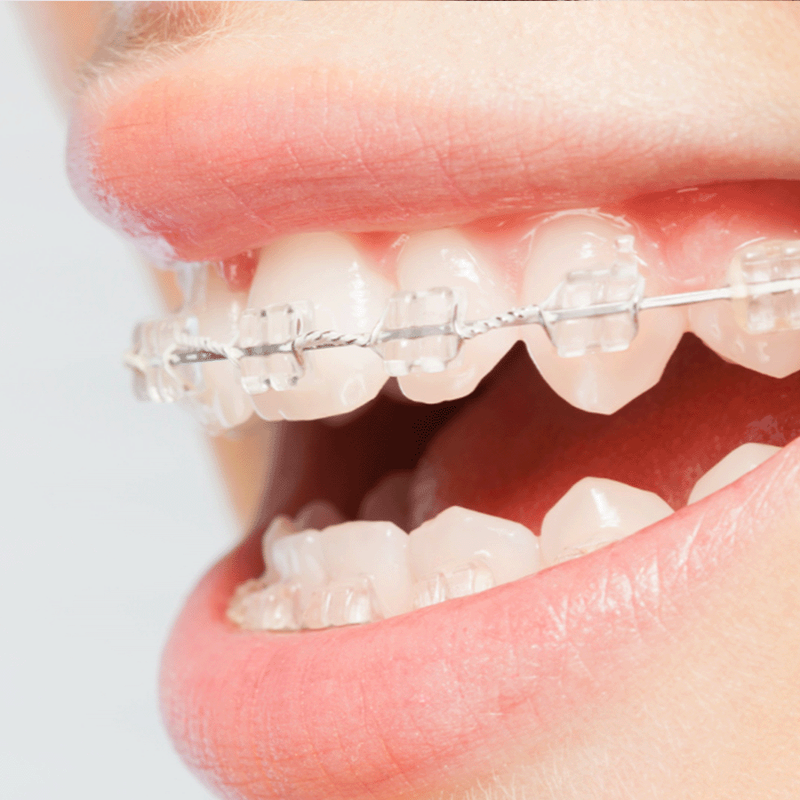 Apparecchi ortodontici estetici invisibili