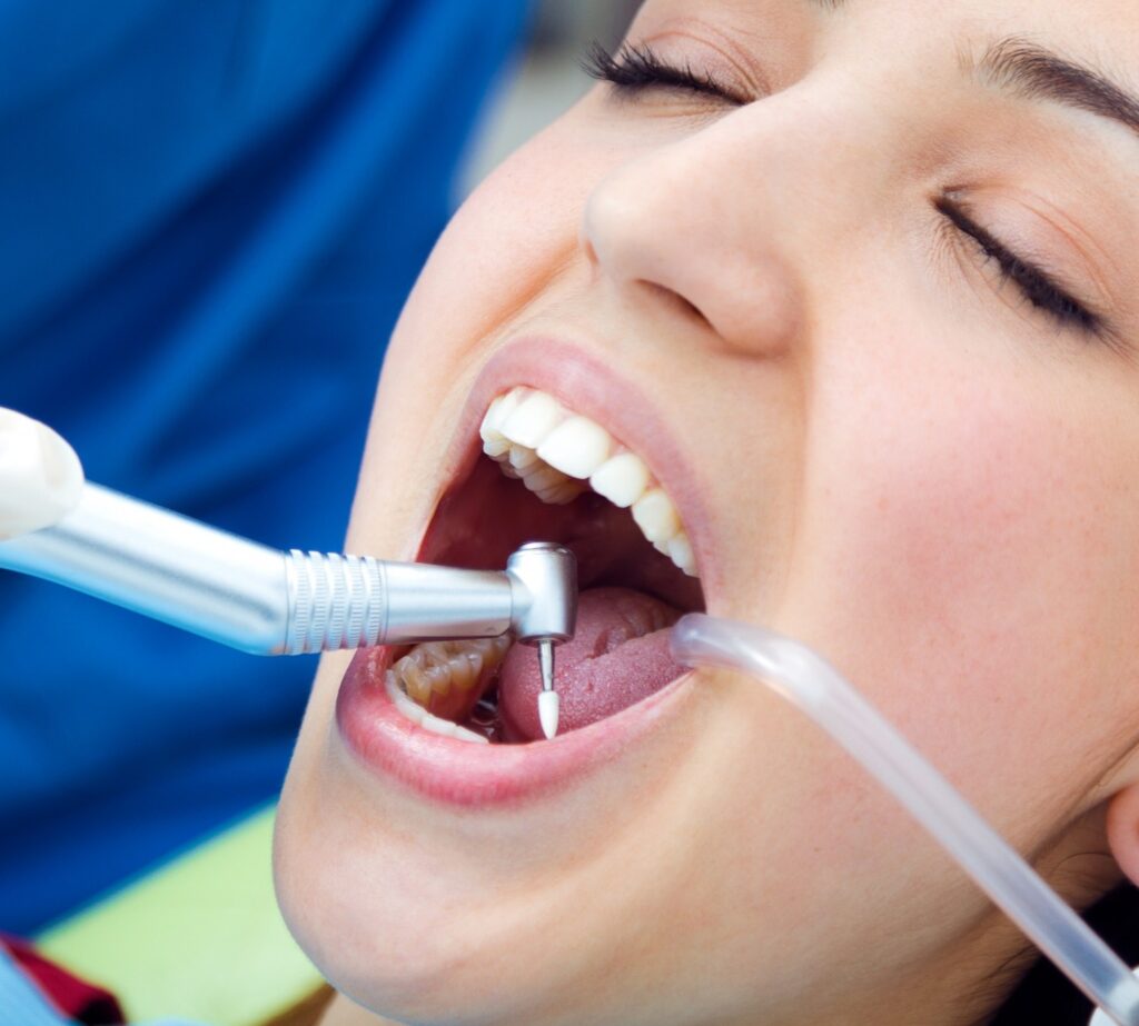 terapia canalare dentale devitalizzazione